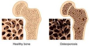 kostní osteoporóza